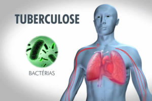 O que é tuberculose ?